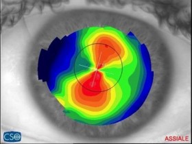TOPOGRAFIA CORNEALE - Studio Oculistico Aiello