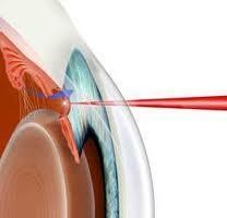 TRABECULOPLASTICA LASER MICROPULSATA :           nuova terapia per il Glaucoma - Studio Oculistico Aiello
