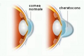 Che cos'è il Cheratocono ? - Studio Oculistico Aiello